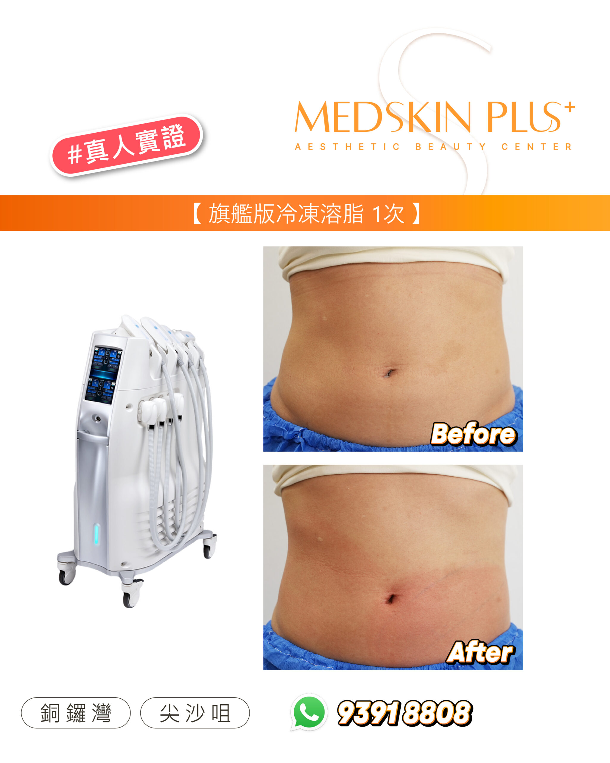 MEDSKIN PLUS+ #真人實證圖片，展示旗艦版冷凍溶脂療程 1 次後腹部側面的 Before 與 After 對比，左側為裝有多個探頭的冷凍溶脂儀器。