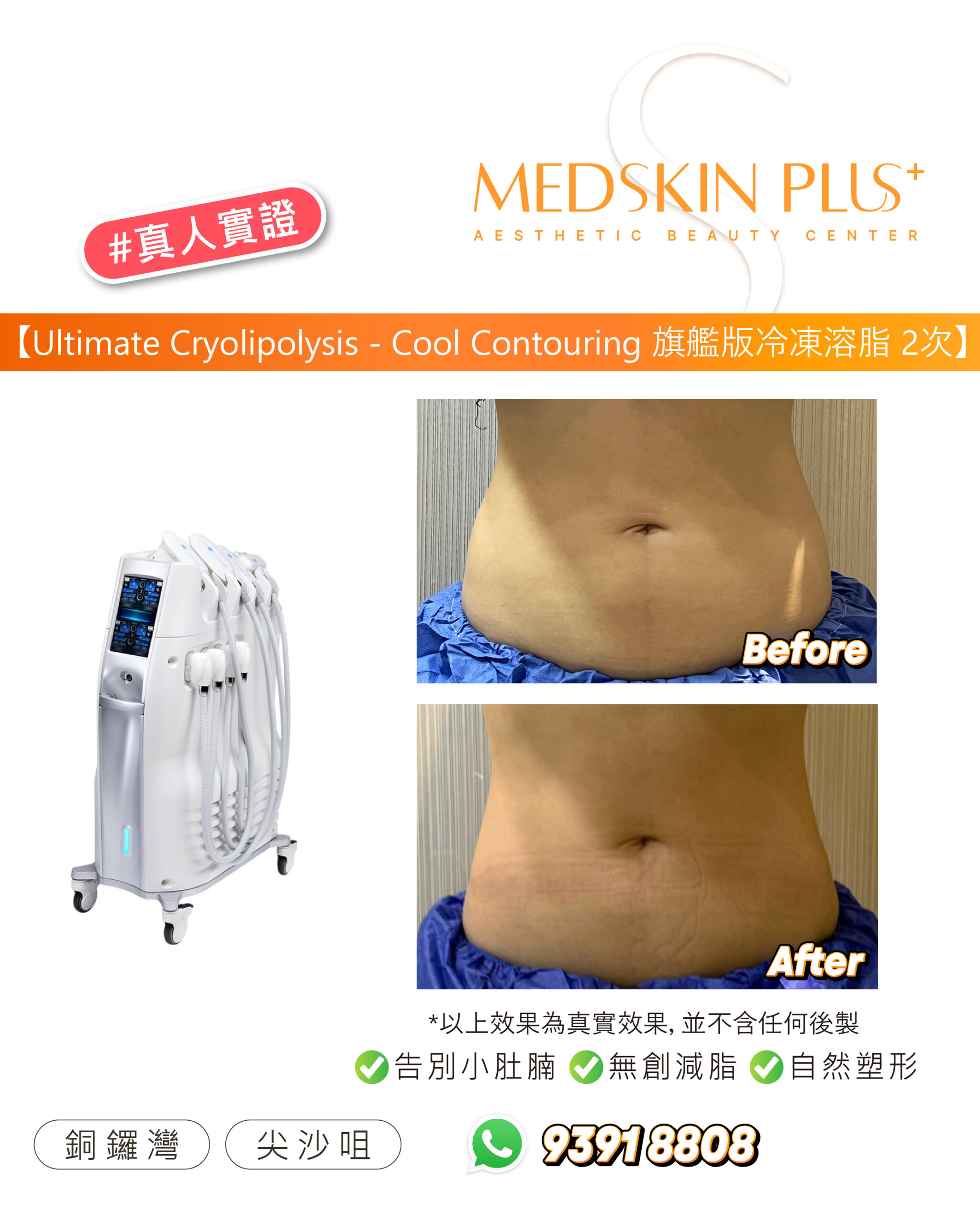 腹部療程前後對比，上格標 Before、下格標 After，女士腹部正面覆蓋藍色治療布，背景為淺灰色牆與布簾，左側為白色冷凍溶脂儀器。