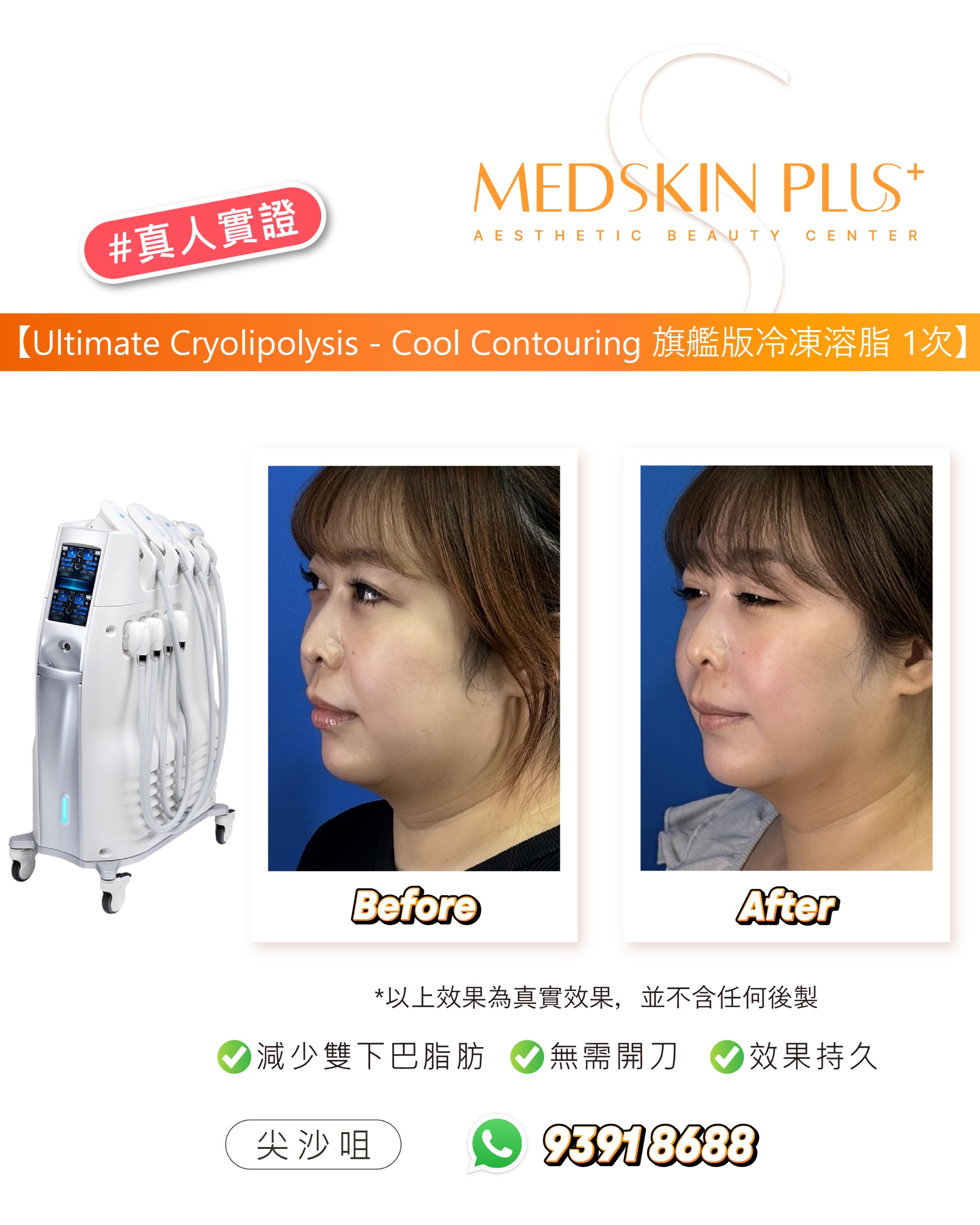 冷凍溶脂廣告圖，左邊為附多個探頭的白色冷凍溶脂儀器，右邊並排展示同一名女士的側面 Before 與 After 對比照