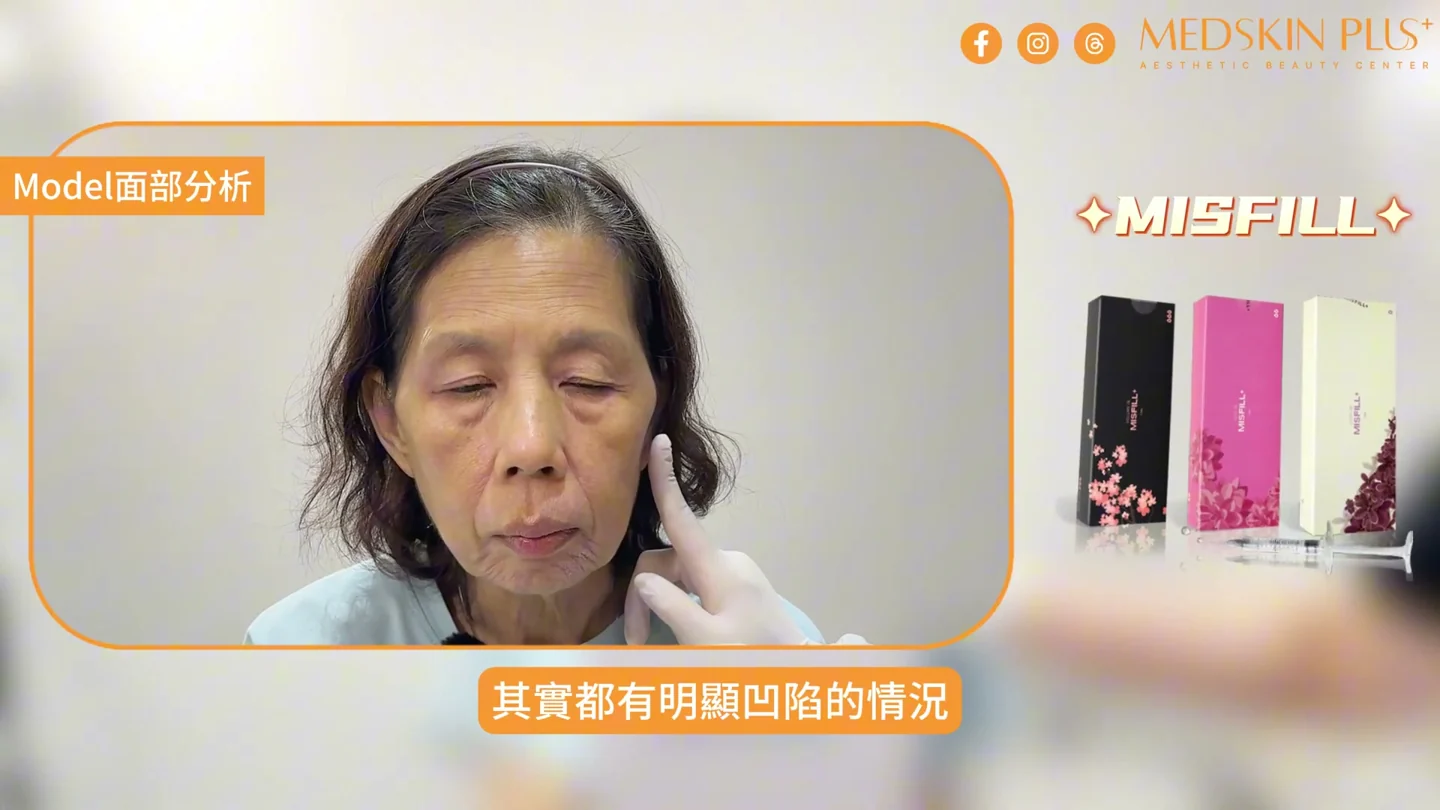 65歲模特兒面頰凹陷及輪廓狀況實錄