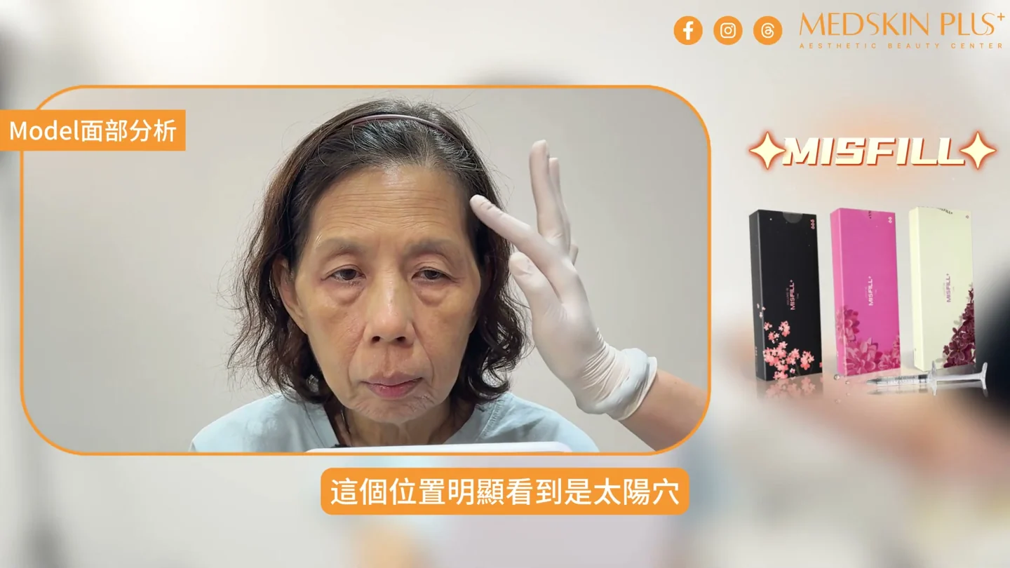 65歲模特兒接受太陽穴凹陷及外輪廓評估
