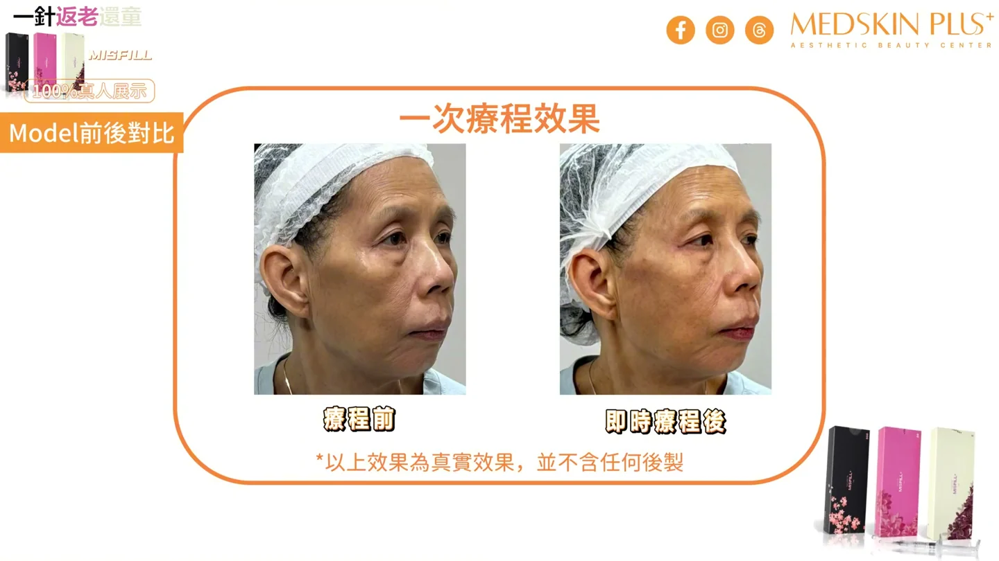 MISFILL+ 原片標示注射前與即時注射後的右側對比