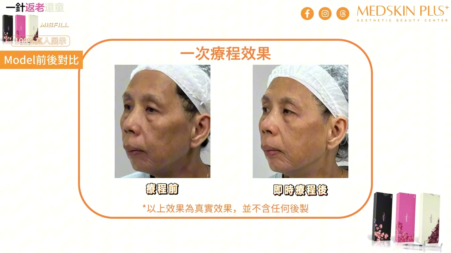 MISFILL+ 原片標示注射前與即時注射後的另一側對比
