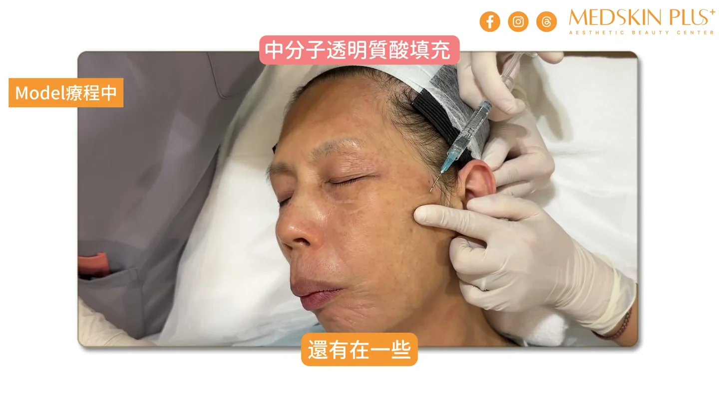 醫生處理模特兒側面輪廓支撐位置的療程紀錄